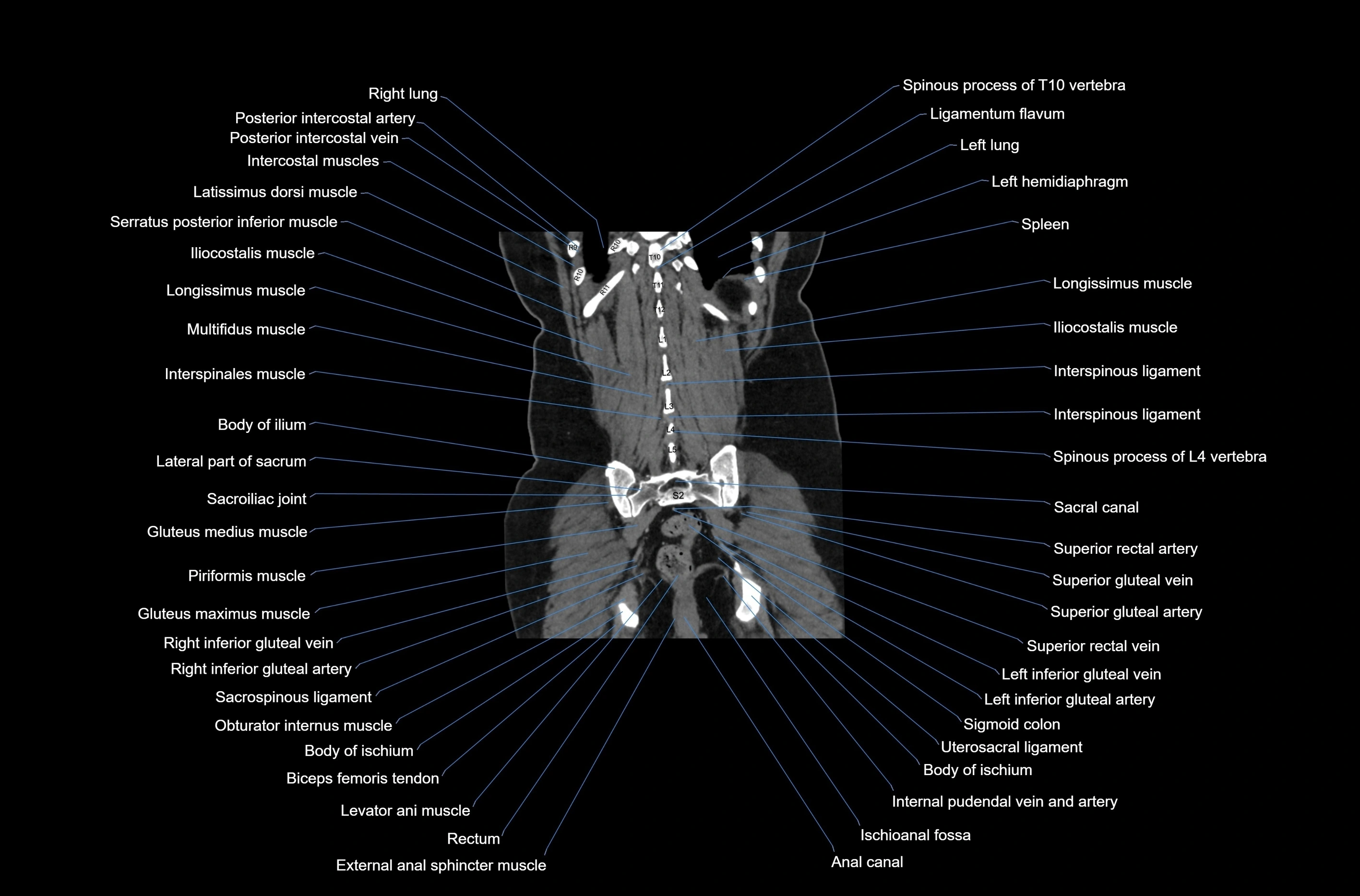 CT abdomen coronal cross sectional anatomy labelled radiology image-00071.webp